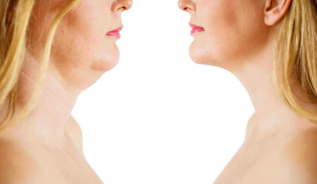 Double Chin treatment Southampton before and after results