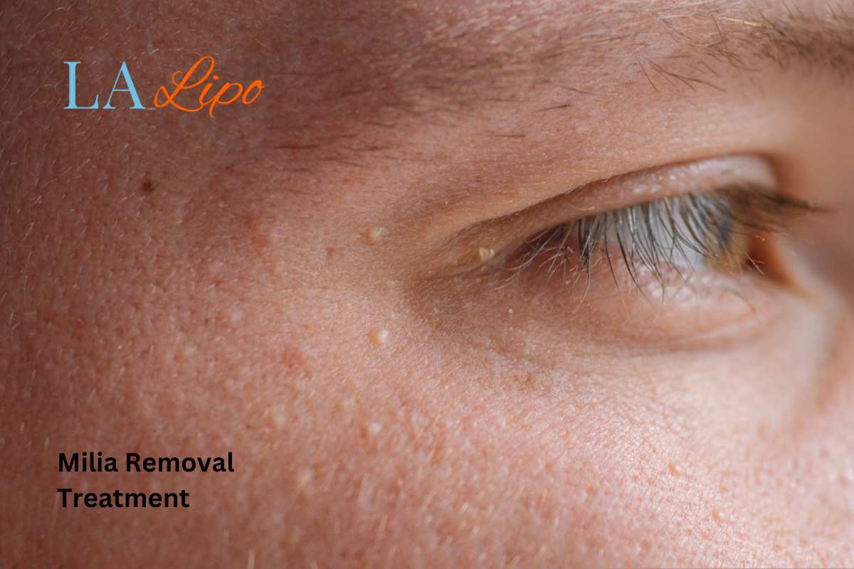 Cryopen Milia Removal: Is It the Easiest and Safest Option Southampton?