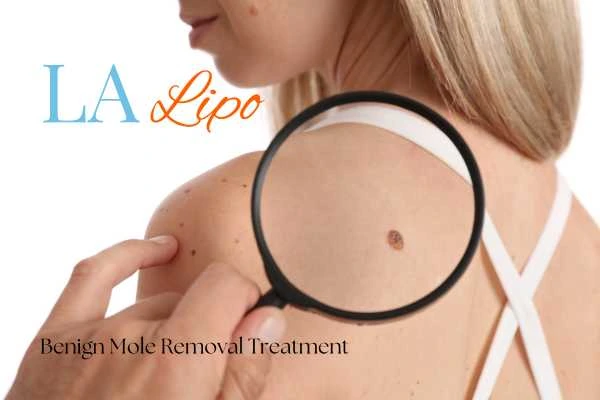 Woman having her inspection of blemish before mole removal Southampton