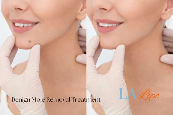 Before and after mole removal Southampton treatment