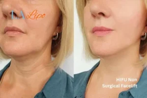 hi-fu for wrinkles Southampton before and after results