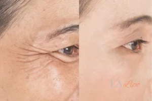 Before and after results of woman - HI-fu wrinkles reduction treatment Southampton