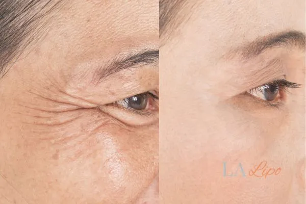 Before and after results of woman - HI-fu wrinkles reduction treatment Southampton