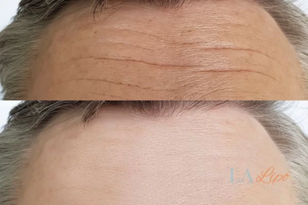 results of HIFU Southampton on mans forehead to help reduce lines and wrinkles