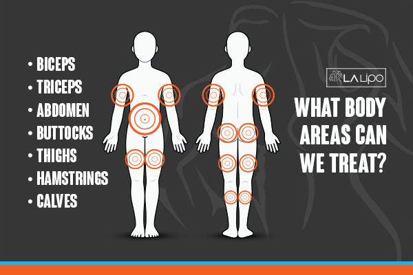 Graphic to show areas you can have LA-EMS Body Sculpting Southampton treatment.
