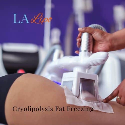 fat freezing - Cryolipolysis Southampton