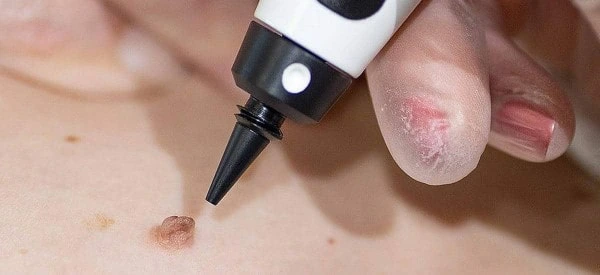 skin tag removal using cryopen Southampton