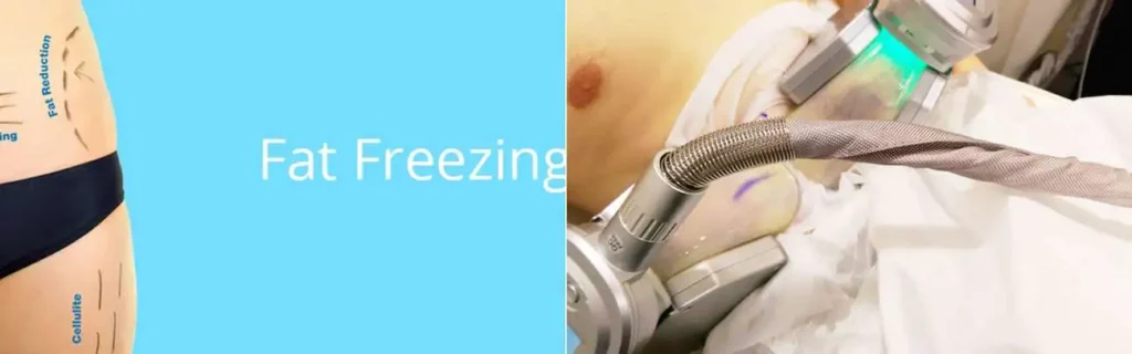 multi areas of a persons body having coolsculpting Southampton treatment