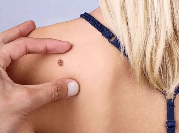 woman having mole removal Southampton consultation before treatment.