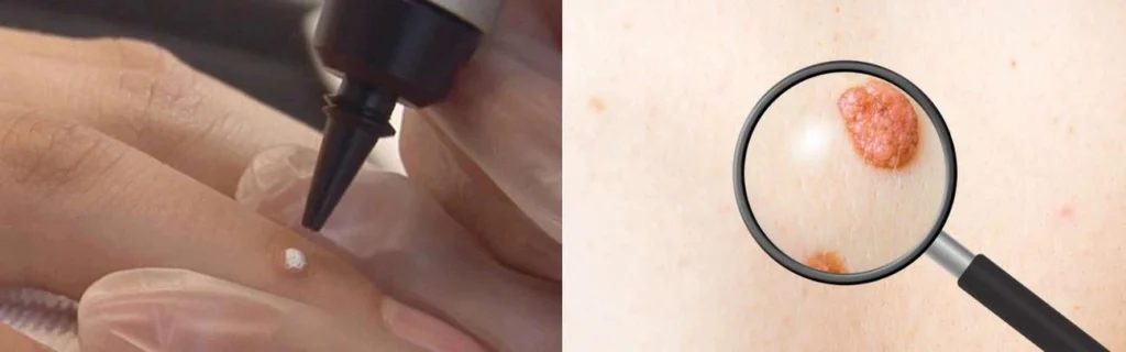 Person getting moles removed with cryopen Southampton