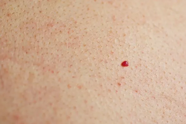 close up of a cherry angioma Southampton