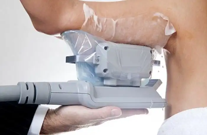 Picture of fat freezing Southampton on the upper arms.