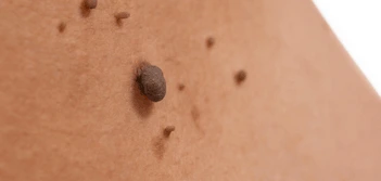 image of a skin tag Southampton
