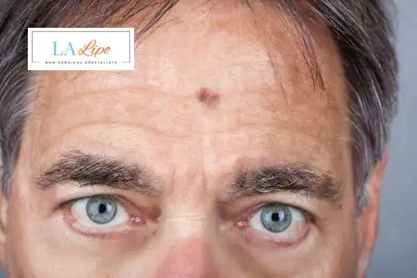 Solar Lentigo Removal Southampton image of man with mark on his forehead