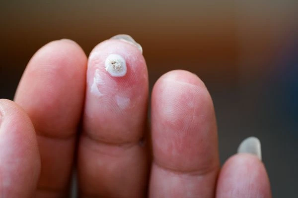 wart on person finger - cryotherapy to treat from LA LIPO Southampton