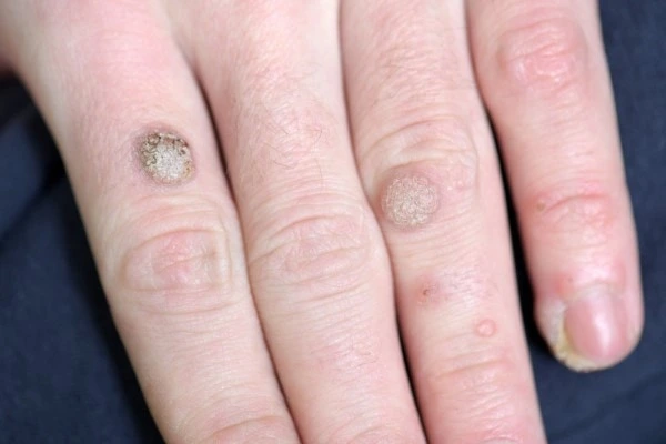 photo of warts on person hand - see wart removal Southampton from LA LIPO