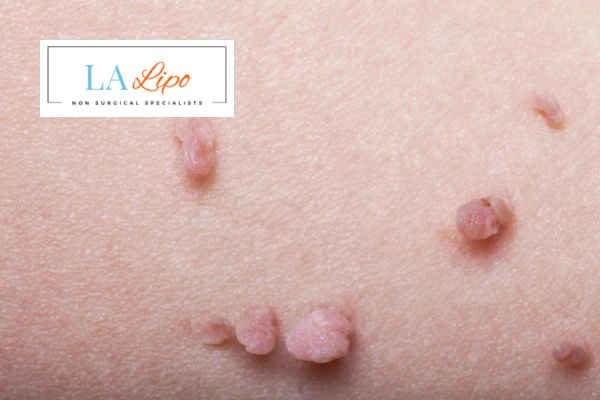 Does cryopen skin tag removal Southampton hurt? Find out now call our team today!