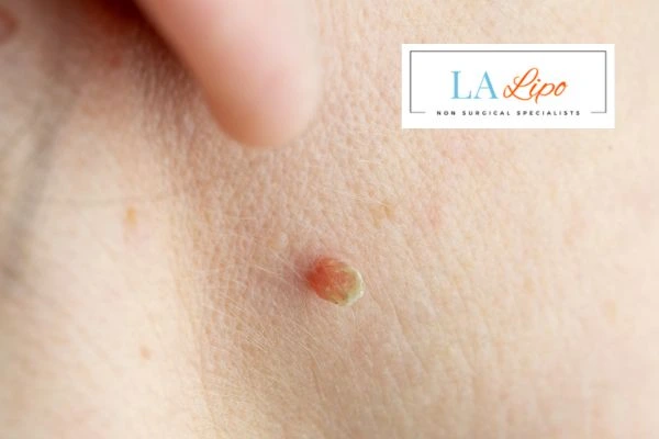 Book skin tag removal Southampton today speak to our team now!