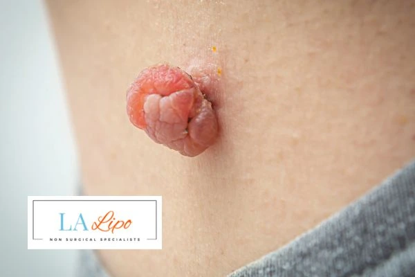 Interested in skin tag removal Southampton? Concerned about the pain? Find out more today!