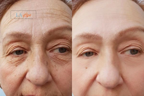 The powerful benefits of Morpheus8 Treatment Southampton - Call Our team today!