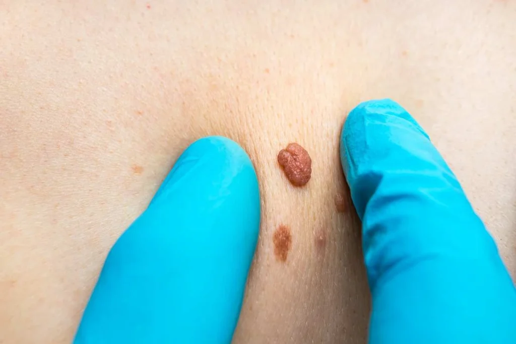 LA LIPO Cryopen Lesion Removal Prices Southampton
