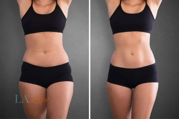 before and after results of non-surgical treatment to help a woman's body image and mental health Southampton