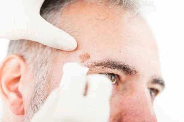 Age spots and elderly people Southampton what is the link?