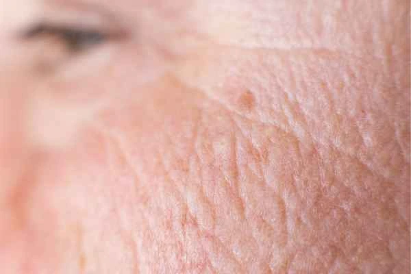 close up picture of a woman's face showing an age spot Southampton