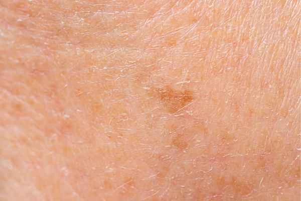 close up picture of age spots Southampton