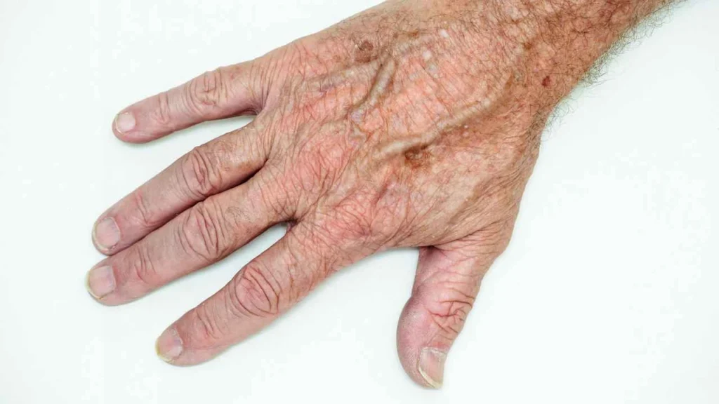 Male hand showing age spot Southampton