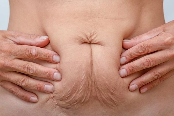 Image of a woman's stomach with loose skin - example of skin tightening Southampton options
