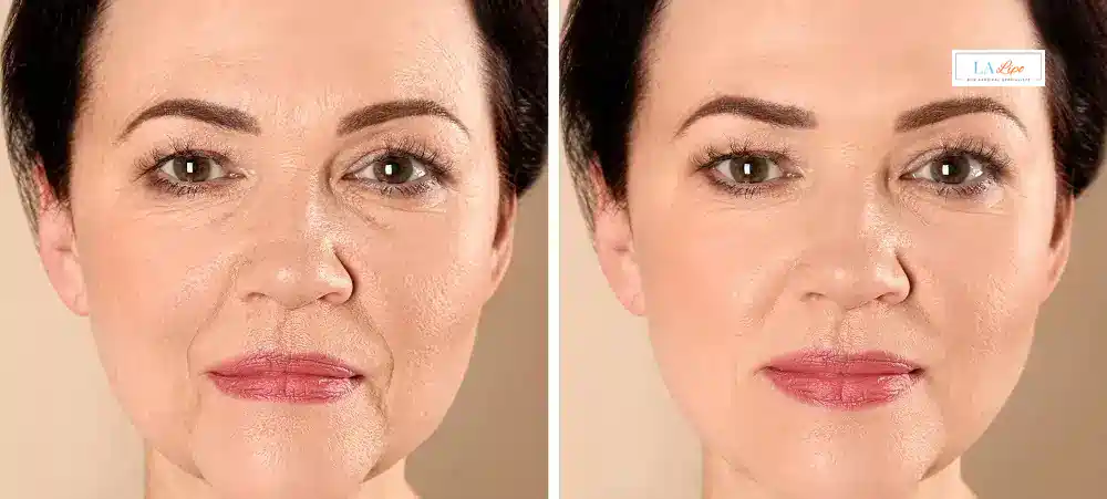 How Long Does It Take to See Results and How Long Do They Last Southampton?