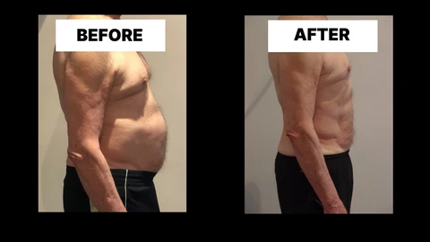 What Symptoms Can Diastasis Recti Cause in Men? Weak Core, Back Pain and Poor Posture Southampton
